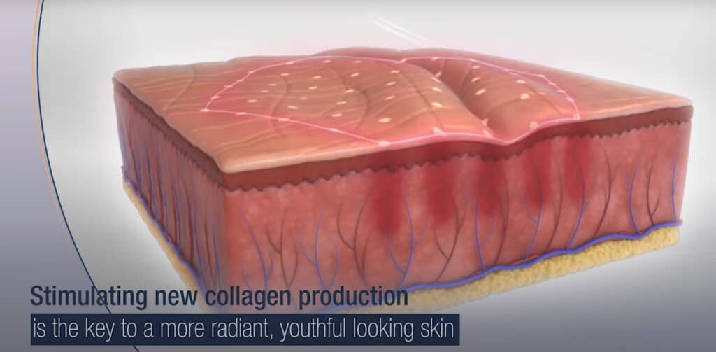 ResurFX Treatment kanali