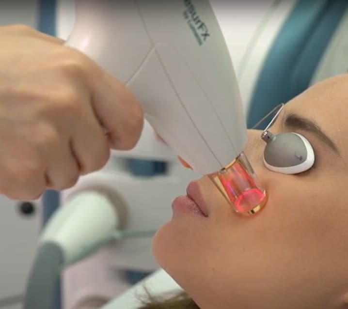 resurfx skin resurfacing device