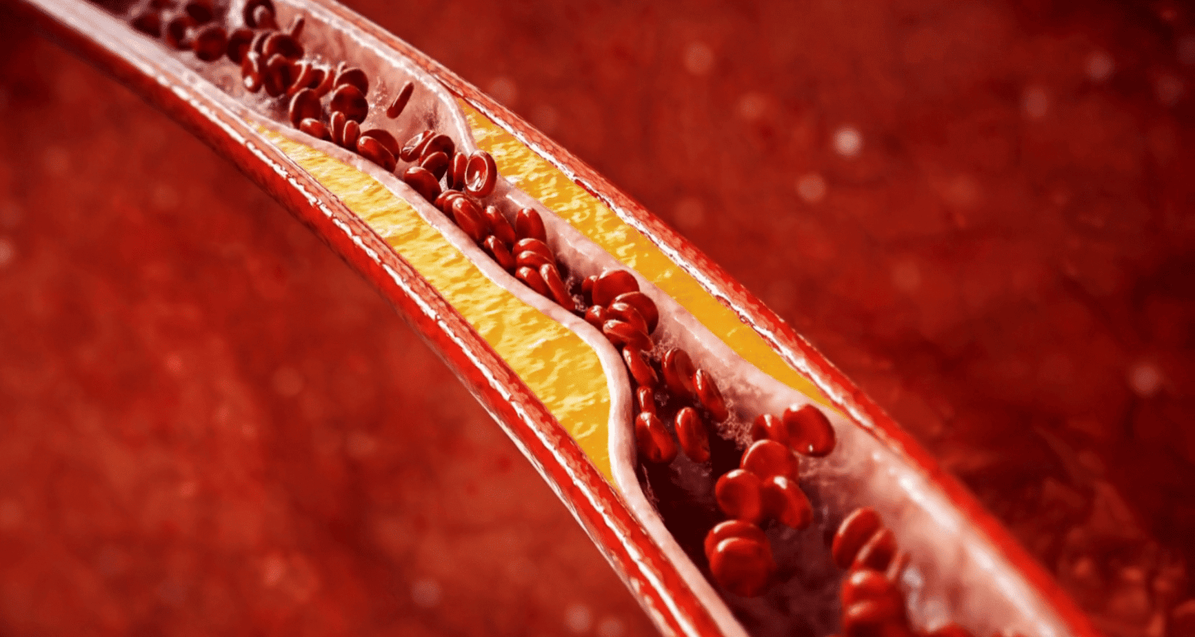 Атеросклерозата е скритата причина за инфаркти и инсулти. Разберете как се развива, какви са симптомите и как можете да се предпазите ефективно.
